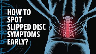 Slipped Disc Symptoms You Shouldn’t Ignore [upl. by Sukramaj934]