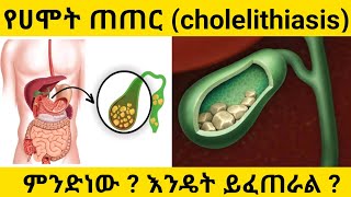 የሀሞት ጠጠር cholelithiasis ምንድነው  እንዴት ይፈጠራል ፣ ምልክቶቹ እና ህክምናው [upl. by Treble]