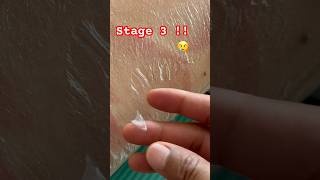 Skin Peeling 😢Skin Sunburn peelingaloeSunburntaloeveraaloeveragelVacationasmr [upl. by Hsirk]