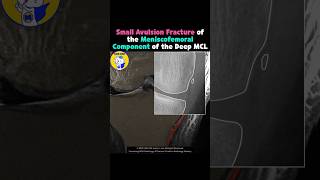 Fig 3A22 Avulsion fracture of meniscofemoral ligament [upl. by Ahsyak]