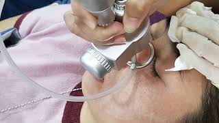 LASER CO2 FRACTIONAL TREATMENT [upl. by Mahalia999]