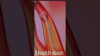 Complete procedure of Angioplasty healthslashHeatattack [upl. by Moyer]