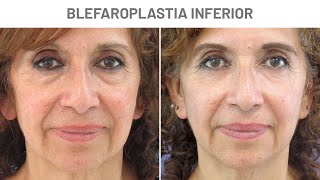 Eliminar las bolsas de los ojos  BLEFAROPLASTIA INFERIOR [upl. by Heins771]