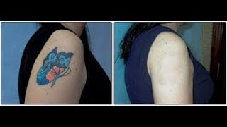 Tattoo Removal With Salt  Heroic But Cheap [upl. by Vernita626]