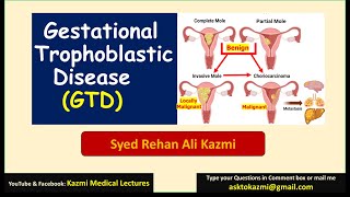 Gestational Trophoblastic Disease  Molar pregnancy  Obstetric review  KML [upl. by Ettenel]