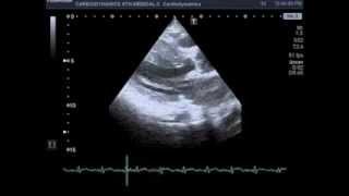 HCM with rupture of mitral chordae tendineae [upl. by Euqor]