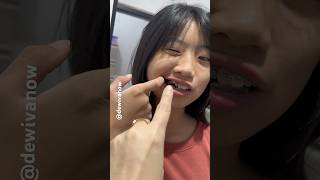 Cece ompong dewivanow cabutgigi dentist doktergigi ompong [upl. by Yerffeg]