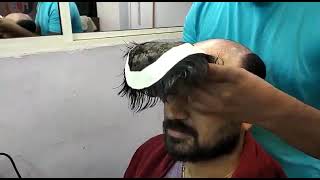 NonSurgical Hair Replacement in kerala [upl. by Corella264]