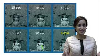 Prolactinoma DAMS Medicine Unplugged Integrated Microadinoma [upl. by Kazimir114]