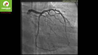 Spontaneous Dissection of Coronary Arteries A Rarity [upl. by Lupee]