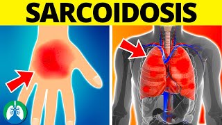 Sarcoidosis Medical Definition  Quick Explainer Video [upl. by Schluter577]