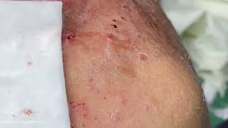 Big Cystic Acne Blackheads Extraction Blackheads amp Milia Whiteheads Removal Pimple Popping [upl. by Valera]