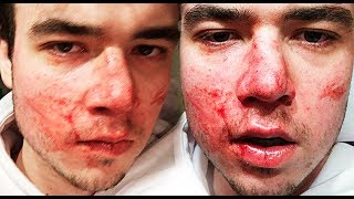 I got jumped broken nose [upl. by Phillada]