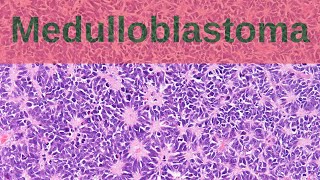 What are Medulloblastomas  Pathology mini tutorial [upl. by Amled]