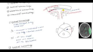 Epidural Hematoma Subdural hematoma Subarachnoid hematoma Intracerebral hemorrhage [upl. by Uwkuhceki]