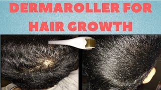 How To Regrow Hair With A Dermaroller Properly [upl. by Onitnerolf]