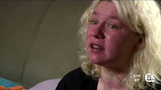 Akron woman experiences rare skin reaction after allergic reaction to medication [upl. by Bristow]