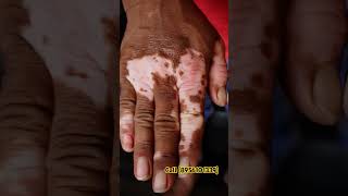 Vitiligo skin colouring safeddaag ilaj vitiligo micropigmention vitiligotreatment microvitiligo [upl. by Eillor605]