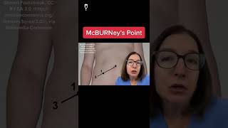 McBurneys point MedicalSurgical SHORT [upl. by Aruol]