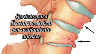 Ejercicios para FRACTURA VERTEBRAL POR ACUÑAMIENTO ANTERIOR  Vértebra dorsolumbar [upl. by Aihtnamas]