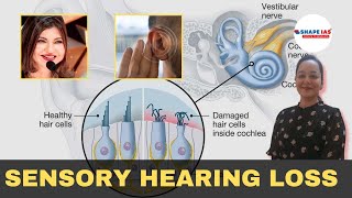 Sensory Hearing Loss  Akanksha Mam  UPSC CSE  Depth Scan [upl. by Einnej]