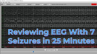 EEG with 7 seizures in 25 minutes [upl. by Miun308]