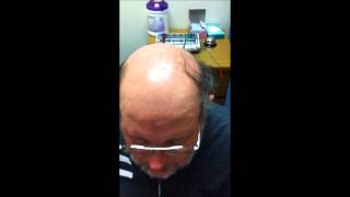 Integrating Scalp Acupuncture and Speech Therapy for Treatment of Dysarthria with GREAT result [upl. by Cheri765]