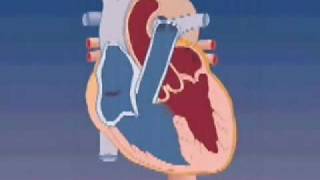 Tetralogy of Fallot [upl. by Gustafson]