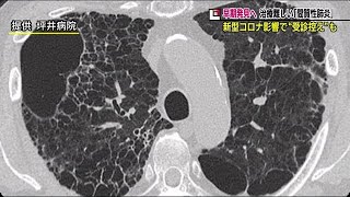 ただの肺炎と思ったのに…余命宣告【間質性肺炎】長引く咳・息切れが難病のおそれも 軽視せず早期発見を 220402 2100 [upl. by Deanne576]