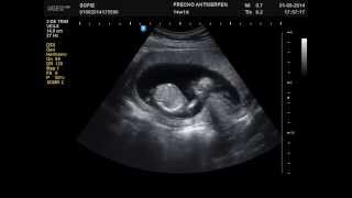 14 Weeks Pregnant 2D Ultrasound Active Baby [upl. by Sucam]