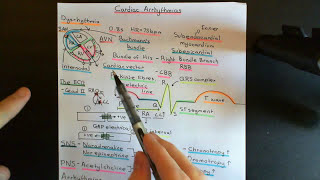 Cardiac Arrhythmias Part 4 [upl. by Guglielma]