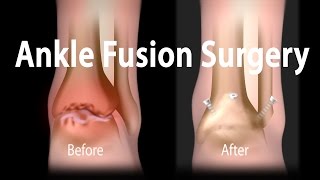 Ankle Fusion Surgery Animation [upl. by Nosiram]