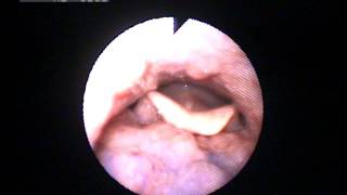 VOICE TECHNIQUES NASENDOSCOPY  Voice onsets amp qualities [upl. by Nai]