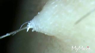 Best compilation of ingrown hair plucking Scabs and gross hairs too [upl. by Anivas]