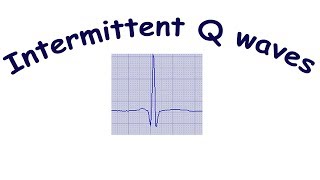 Intermittent pathological Qwaves [upl. by Asilehc]