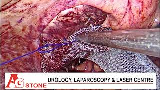 laparoscopic sacrocolpopexy [upl. by Ettenel537]