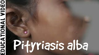 Dermatology  Case Discussion  Pityriasis alba  Dr Suchana Marahatta [upl. by Oliric]