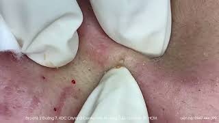 Big Cystic Acne Blackheads Extraction Blackheads amp Milia Whiteheads Removal Pimple Popping [upl. by Barthold]