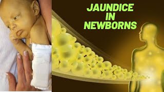 JAUNDICE IN NEWBORNS [upl. by Eimma]