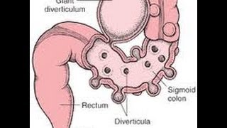 Top 3 Ways To Prevent Diverticulitis Attacks [upl. by Yatnwahs]