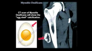 Myositis Ossificans  Everything You Need To Know  Dr Nabil Ebraheim [upl. by Richia79]