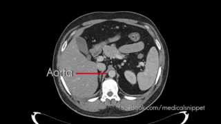 Branches of Abdominal Aorta [upl. by Harbird]