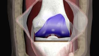 Revision of Knee Replacement Surgery Animation by Cal Shipley MD [upl. by Nivej]