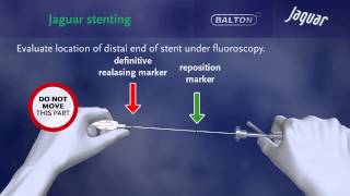 SELFEXPANDING NITINOL STENT quotJAGUARquot with delivery system [upl. by Takeshi684]