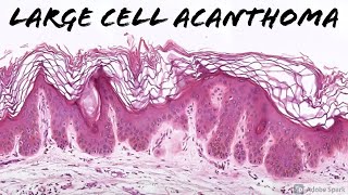 Large Cell Acanthoma 5Minute Pathology Pearls [upl. by Annuahsal637]