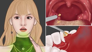 ASMR Get Rid of Bad Breath Tonsil Stone Removal Salivary Glands Cleaning  Mengs Stop Motion [upl. by Aneerahs]