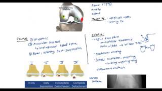 Osteochondritis and Osgood Schlatter for the USMLE [upl. by Enriqueta]