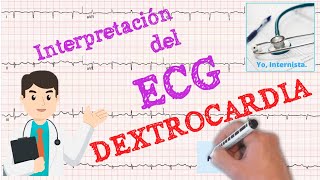 ECG Dextrocardia su análisis [upl. by Teragramyram]