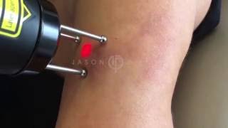 DECREASE ARM PIGMENTATION AND DARK SPOTS WITH ASCLEPION FRACTIONAL RUBY LASER  DR JASON EMER [upl. by Pironi630]