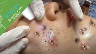 Acne Treatment for Ha Part 4  Make Your Day Relaxing with Windy Spa 6219 [upl. by Belldas455]